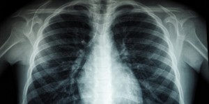 Φυματίωση: Ραγδαία αύξηση των κρουσμάτων σε παιδιά - «Καμπανάκι» από τον ΠΟΥ Φυματίωση: Ραγδαία αύξηση των κρουσμάτων σε παιδιά - «Καμπανάκι» από τον ΠΟΥ