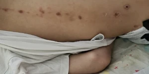 Πάτρα: Μυστήριο με τα σημάδια σε 10χρονο παιδί – Παρέμβαση εισαγγελέα μετά τις αποκαλύψεις Πάτρα: Μυστήριο με τα σημάδια σε 10χρονο παιδί – Παρέμβαση εισαγγελέα μετά τις αποκαλύψεις